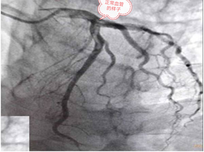心脏|心脏三个大血管，52岁男子两个血管都丢失，手术台上心脏停跳！