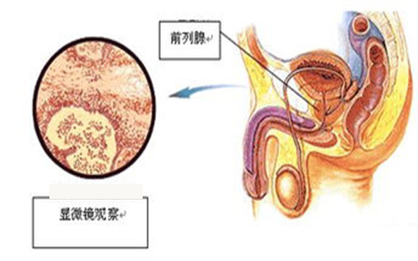 急性細菌性前列腺炎的感染途徑有哪些?|急性細菌性前列腺炎|前列腺|尿