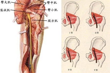 梨状肌综合征|腰椎管狭窄和梨状肌综合征都有间歇性跛行症状，如何鉴别？