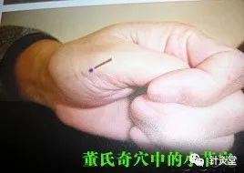 董氏奇穴:【小节穴】穴位讲解