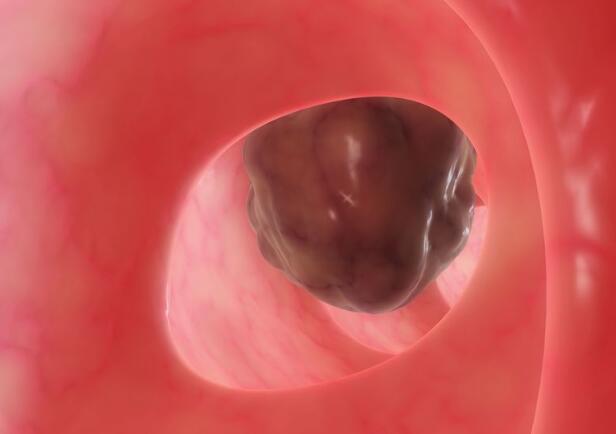 这几个部位长出息肉要及时切除避免发生病变