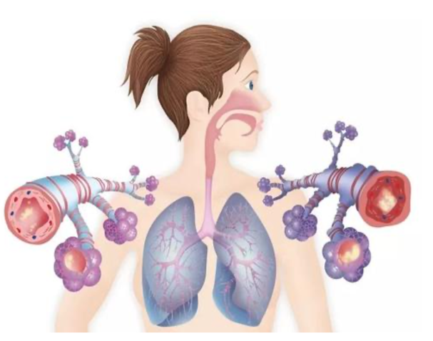 中日友好医院呼吸三部的牛宏涛医生介绍,肺栓塞是血管阻塞(栓子堵 