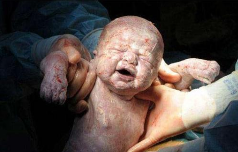 而现在的宝宝一般不会有这么多胎脂,分娩时经过医生擦拭清洗,出生后1