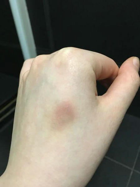 身上经常无缘无故出现淤青?小心背后有大危险!_腾讯新闻