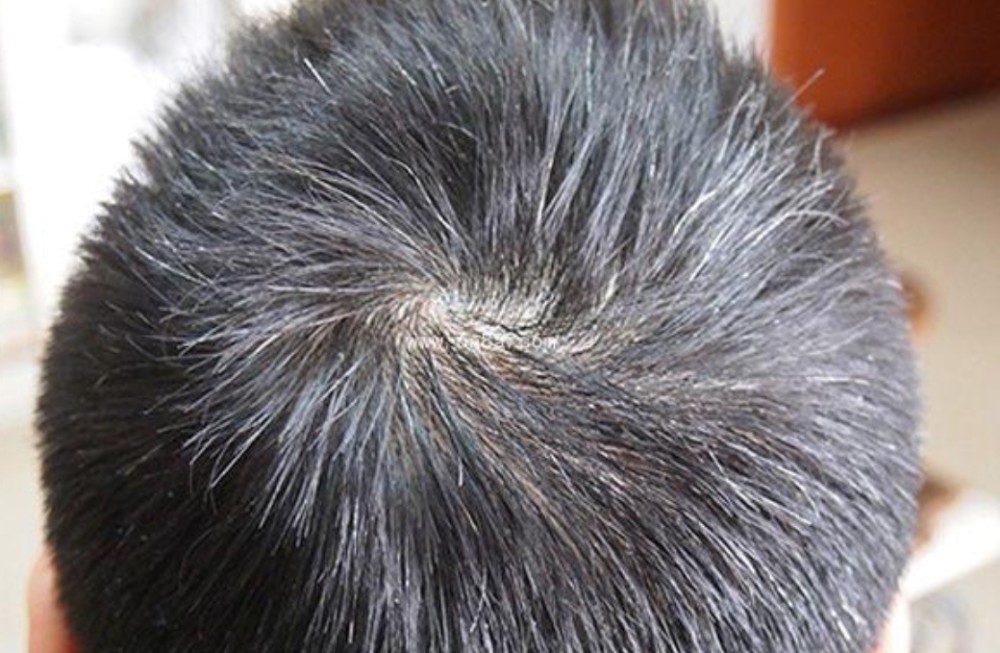 但如今很多青年人都过早出现头发变白的现象,这实际上也被称为少白头.