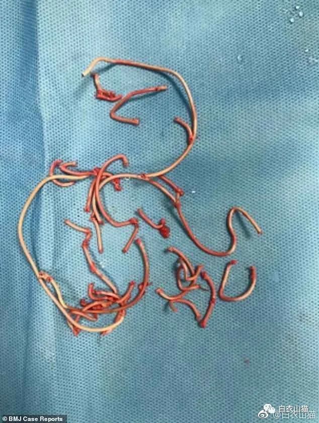 x光下可以看见少年膀胱内异物,图来自bmj.