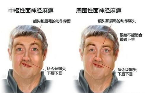 得了面瘫我们应该怎么治疗,嘴歪眼斜好难受|面神经炎|中枢性面瘫|周围