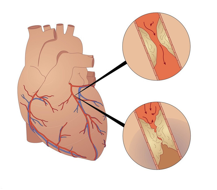 急性心肌梗死|降脂药伤肝，血脂正常后就停药？结果引发心肌梗死！医生辟谣！