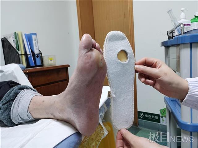 武汉市中心医院内分泌科主任毛红表示,糖尿病性周围神经病变是糖尿病