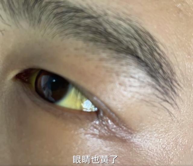 27岁男子一觉醒来全身变黄,尿液更是黄得像浓茶一样