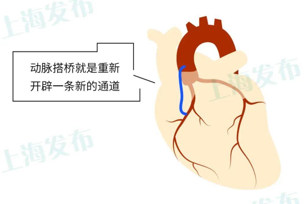 【名医】心脏支架/搭桥怎么选?为啥手术之后的康复特别重要?