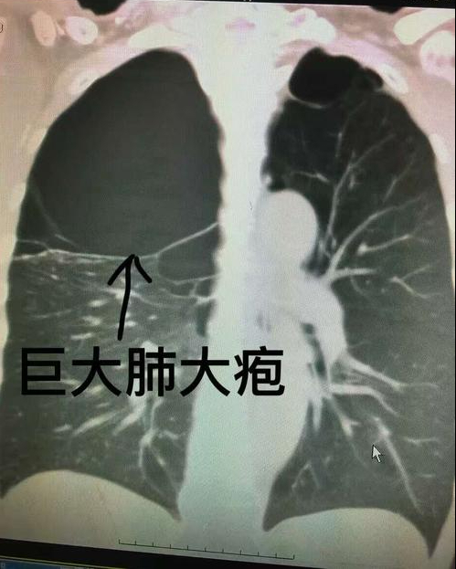 肺大泡的症状有哪些 应该如何治疗 腾讯新闻