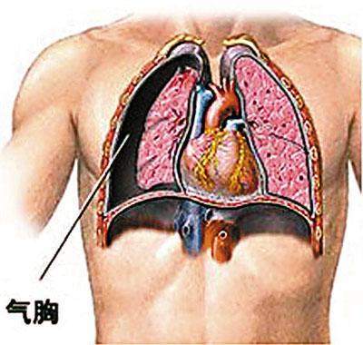 肺大泡的症状有哪些应该如何治疗