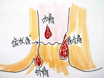 肛肠医院痔疮不好惹该怎样很好的躲开它