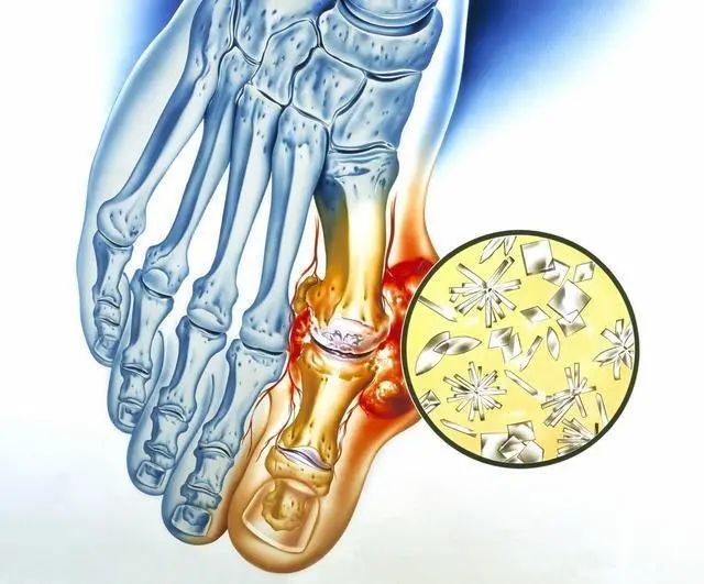 小龙虾|42岁男子吃小龙虾险送命，提示：小龙虾虽好吃，这一种人碰不得