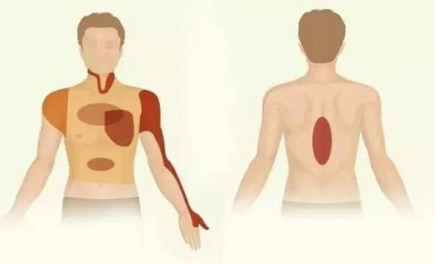 心肌梗塞|这个地方疼真不是骨科病，心跳随时可能停！45岁后互相提醒