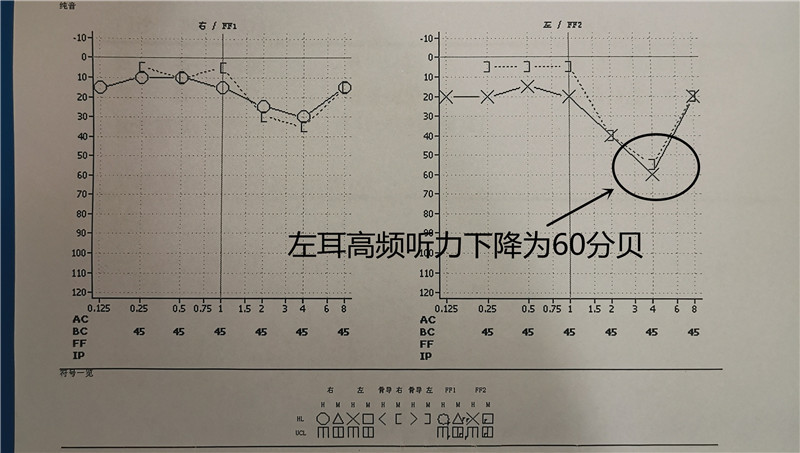 电测听正常图图片