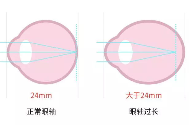 北京近视防控怎么做？从眼轴测量到验光配镜，一份给家长的完整攻略