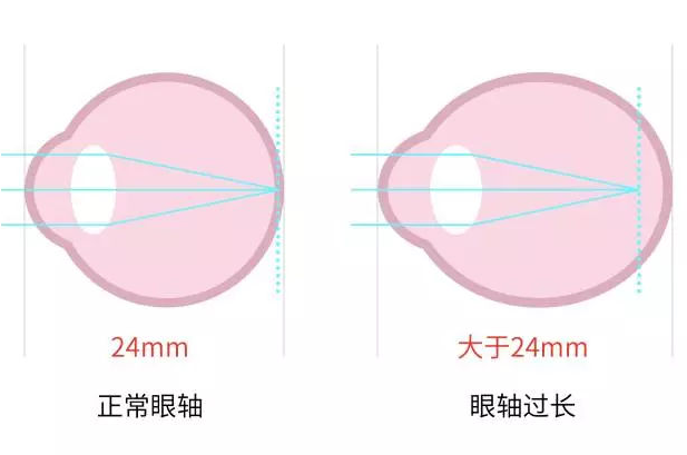 你知道眼睛也有身高嗎眼軸測量對兒童近視發展至關重要