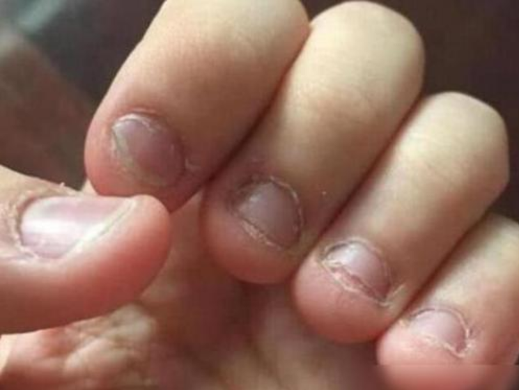 爱咬指甲的孩子以后都怎么样了大都逃不开这几种结局