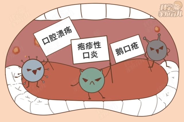 还有一种情况是疱疹性口炎,宝宝起病时会有38℃-40℃的发热,口腔黏膜