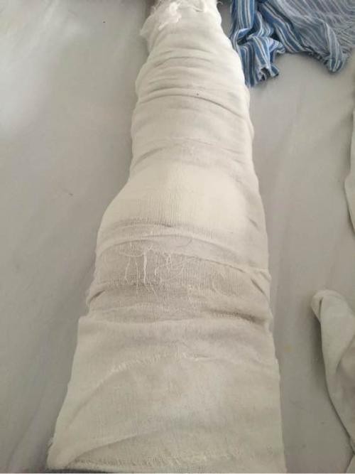 髌骨|固定|石膏