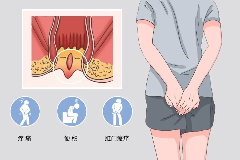 哨兵痔图片 腾讯网