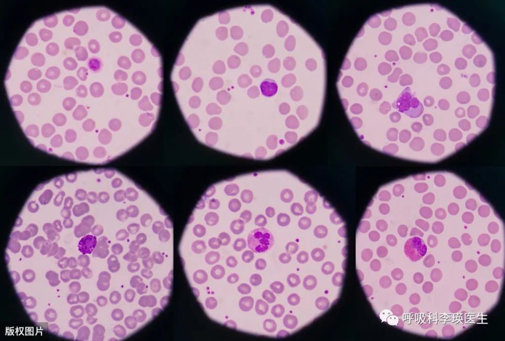 慢阻肺|指南建议：慢阻肺用两种吸入剂，效果不佳，可以换新型双扩剂吗