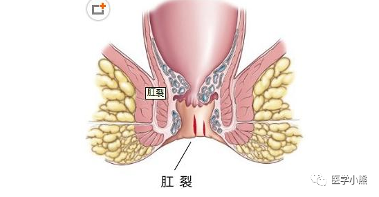 揭秘便血背后的健康秘密