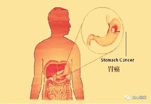 而胃癌中晚期時可能在中上腹觸及包塊,有的還有左鎖骨或腋下淋巴結