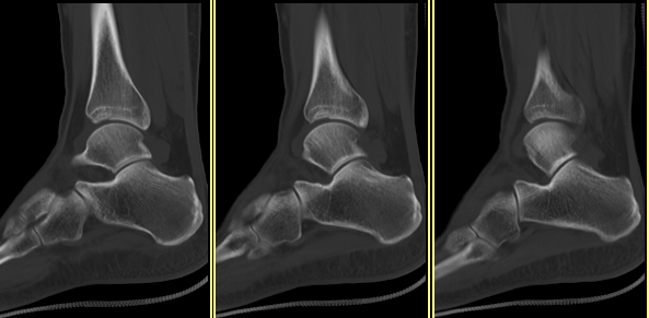 骨折拍個x線片就好了做什麼ctmri