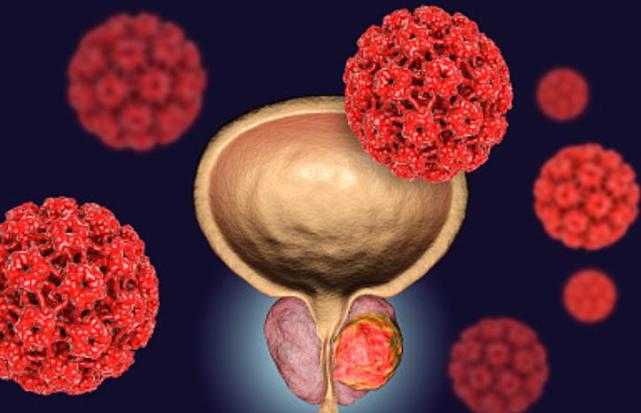 前列腺癌(前列腺癌是幸运的癌症)-第2张图片-鲸幼网