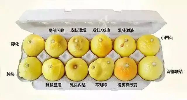 乳癌(乳癌切除乳房后最多能活多久)-第1张图片-鲸幼网