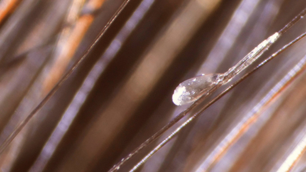 虱子|明明很干净，为什么还会长虱子？什么样的人容易感染虱子？