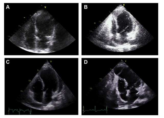 经胸超声心动图(tte)显示:左心室射血分数降低(lvef 30%),前壁,室间隔