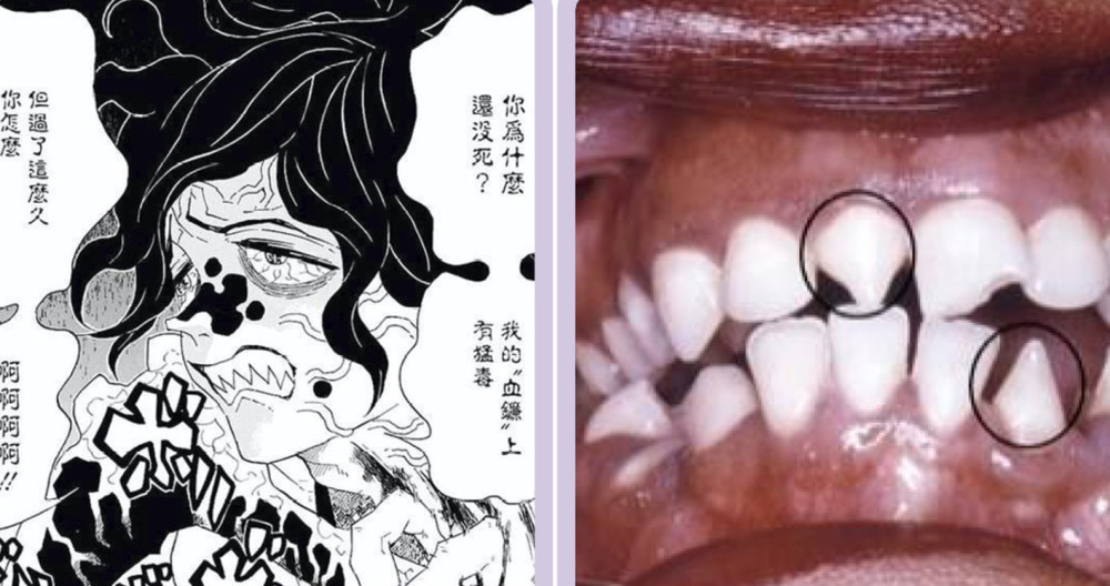 牙齿呈现锯齿状态,这是【先天性梅毒牙】的症状之一,因为遗传梅毒导致