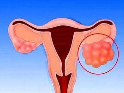 卵巢癌治疗不能一味消灭肿块还应改善患者的体质