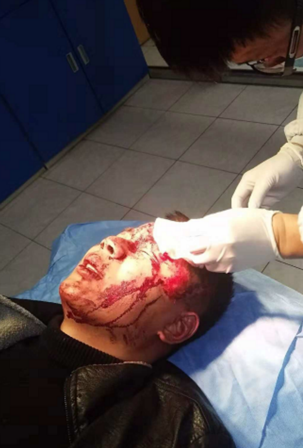 两男子因打瞌睡引发斗殴,年轻小伙挺身而出劝架,被打断鼻梁骨