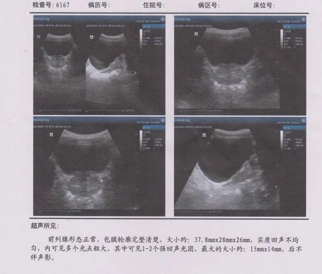 老中医 停止治疗三年 他的前列腺病情后来怎么样了 前列腺 尿频