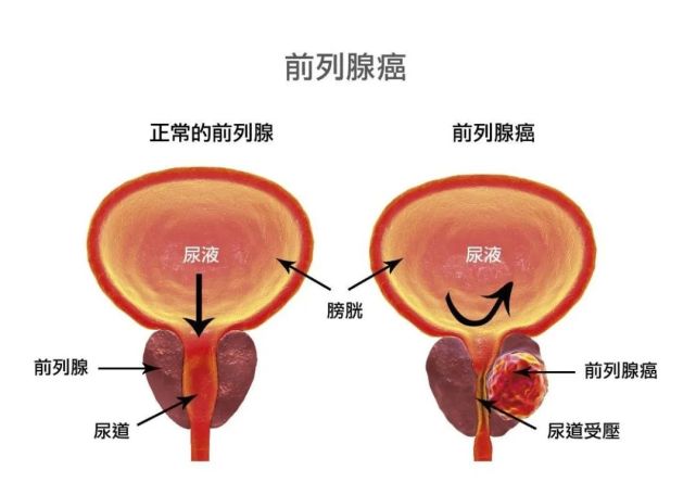 这症状很多人忽视|前列腺特异性抗原|浙江|前列腺癌|癌症晚期|癌症|骨