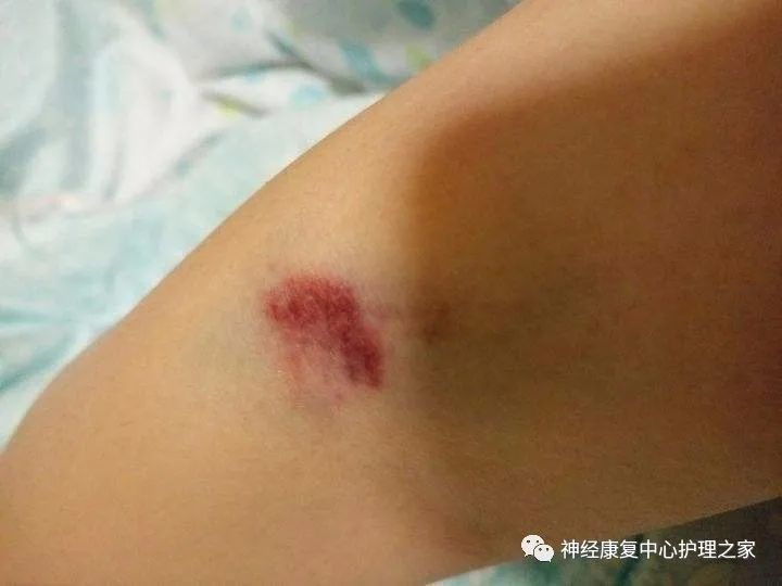 这样的采血后淤血你怕了吗