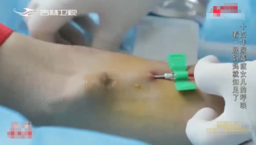 尿毒症|透析的心酸有谁知？镜头下尿毒症女孩的透析过程，让人心疼