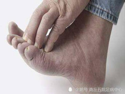 糖尿病并发症|糖尿病人的脚发热是什么原因？
