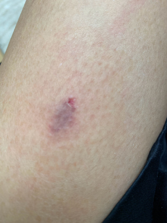 从照片看,蔡少芬的伤口的确不是很大,但伤口处还是淤青了,周围也通红