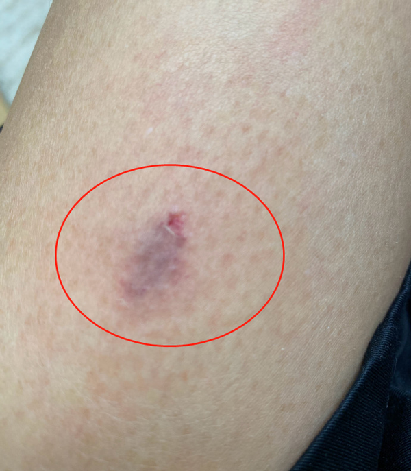 从蔡少芬晒出的这组照片可以看出,她的伤口处不仅有一大块淤青,还破了