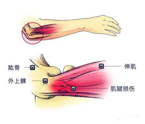 5,肘關節外側疼痛明顯,握物無力,擰毛巾握鼠標等動作時局部疼痛加劇.