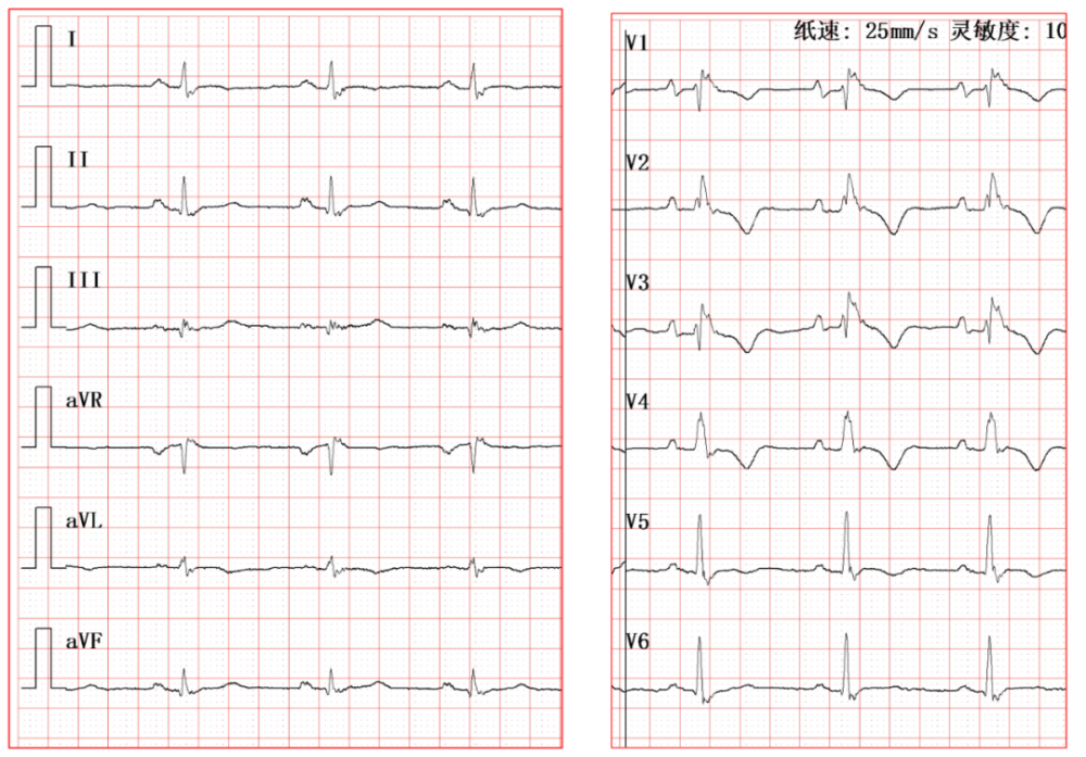 epsilon 波的识别及临床意义|同济专栏_腾讯新闻