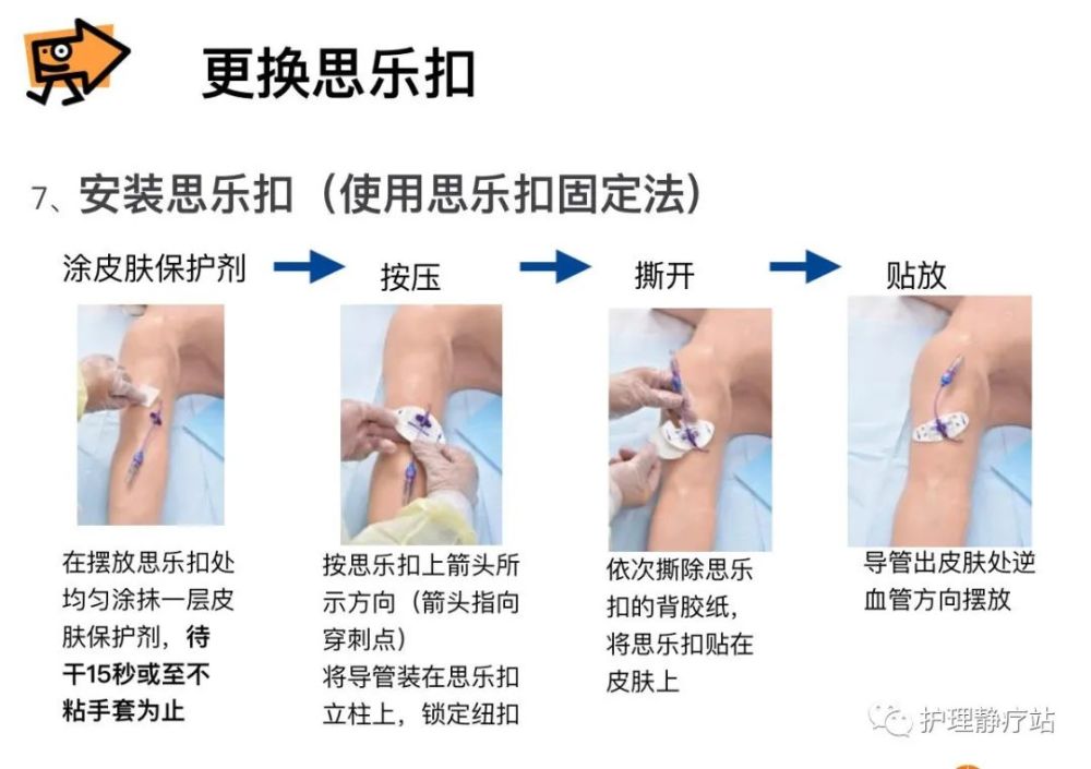 正压封管—picc维护的重要步骤,你做对了吗?_腾讯新闻