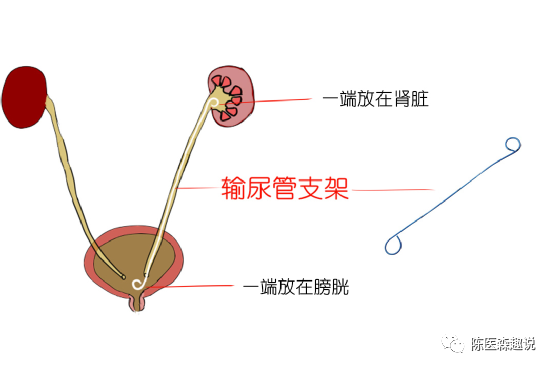 输尿管支架|你知道吗？结石手术后为什么需要放置输尿管支架？