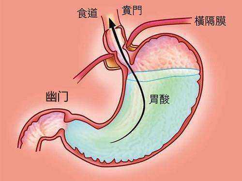 胃食管反流|常被反酸烧心所困扰？5种生活方式改善和预防胃食管反流